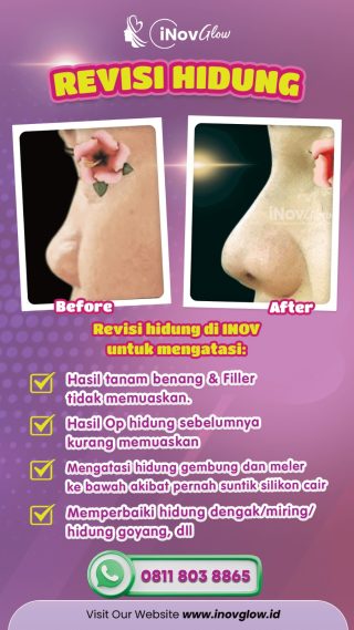 Mengatasi Kekecewaan Rhinoplasty dengan Operasi Revisi Hidung di Inov Glow