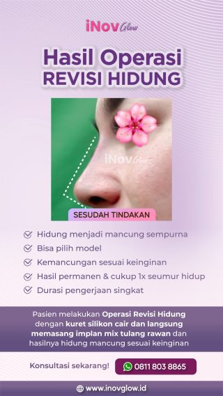 Revisi Hidung