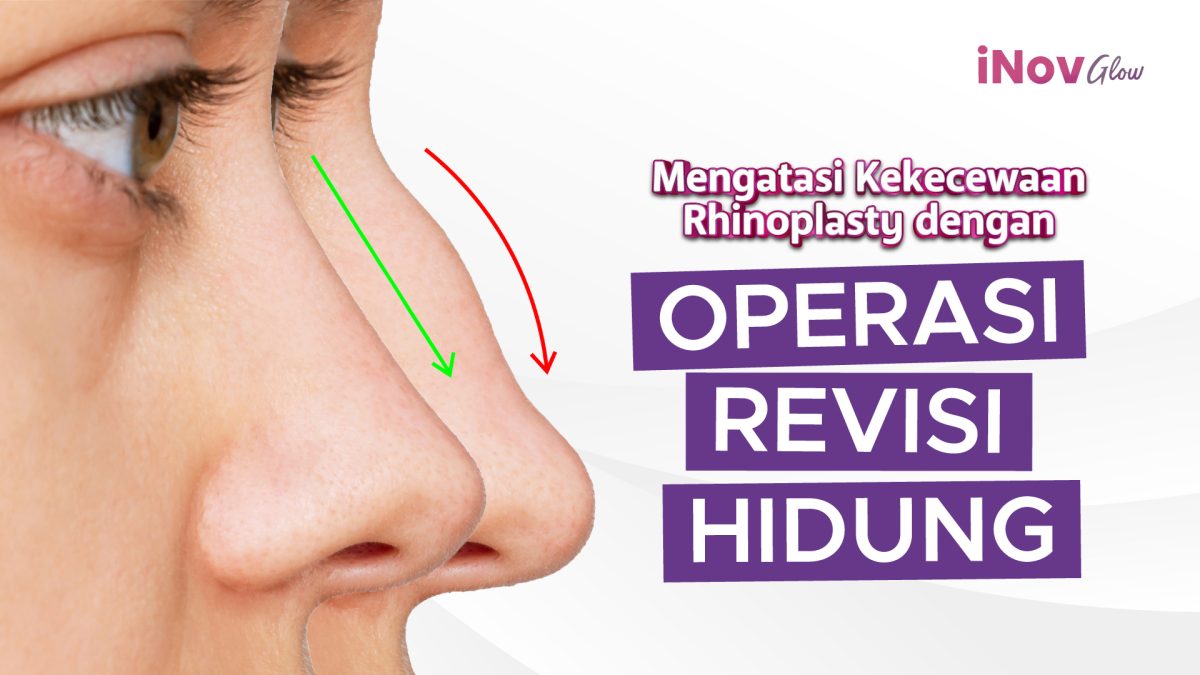 28-November_OPERASI-REVISI-HIDUNG-2-1200x675.jpg