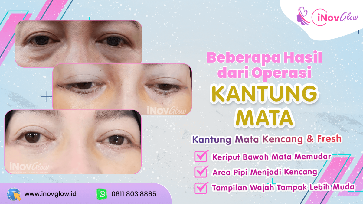 OP-Kantung-Mata-1200x675.png