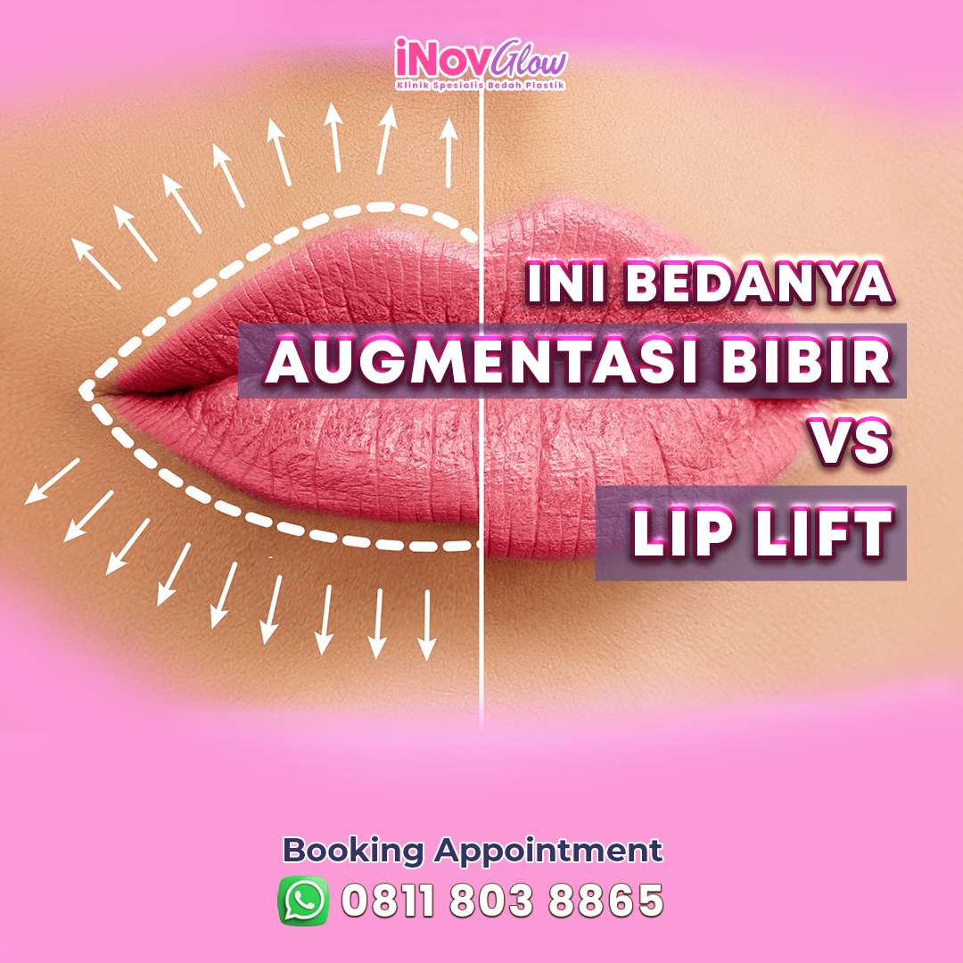 Ini-Bedanya-Augmentasi-Bibir-vs-Lip-Lift-inov-1-.jpg