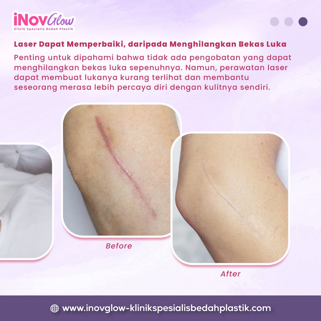 APA ITU LASER BEKAS LUKA? INOVGLOW KLINIK SPESIALIS BEDAH PLASTIK