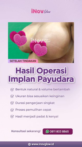 Hasil Kurang Optimal? Revisi Implan Payudara untuk Bentuk Payudara Ideal 
