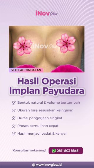 Hasil Kurang Optimal? Revisi Implan Payudara untuk Bentuk Payudara Ideal