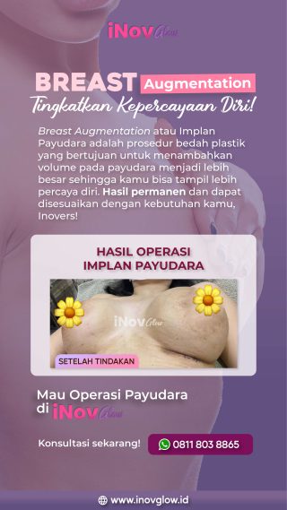 Pengaruh Fluktuasi Berat Badan Terhadap Implan Payudara
