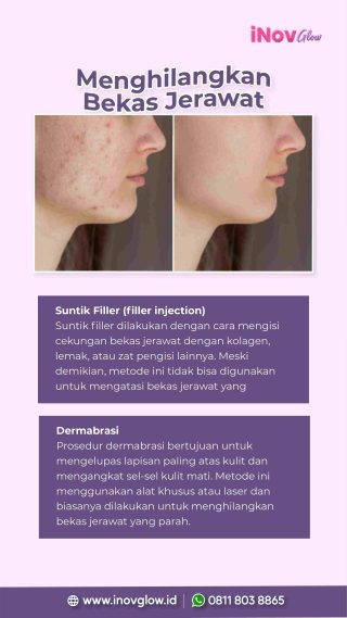 Pilih Mana? Pertimbangan Penting Antara Dermal Filler dan Transfer Lemak Wajah