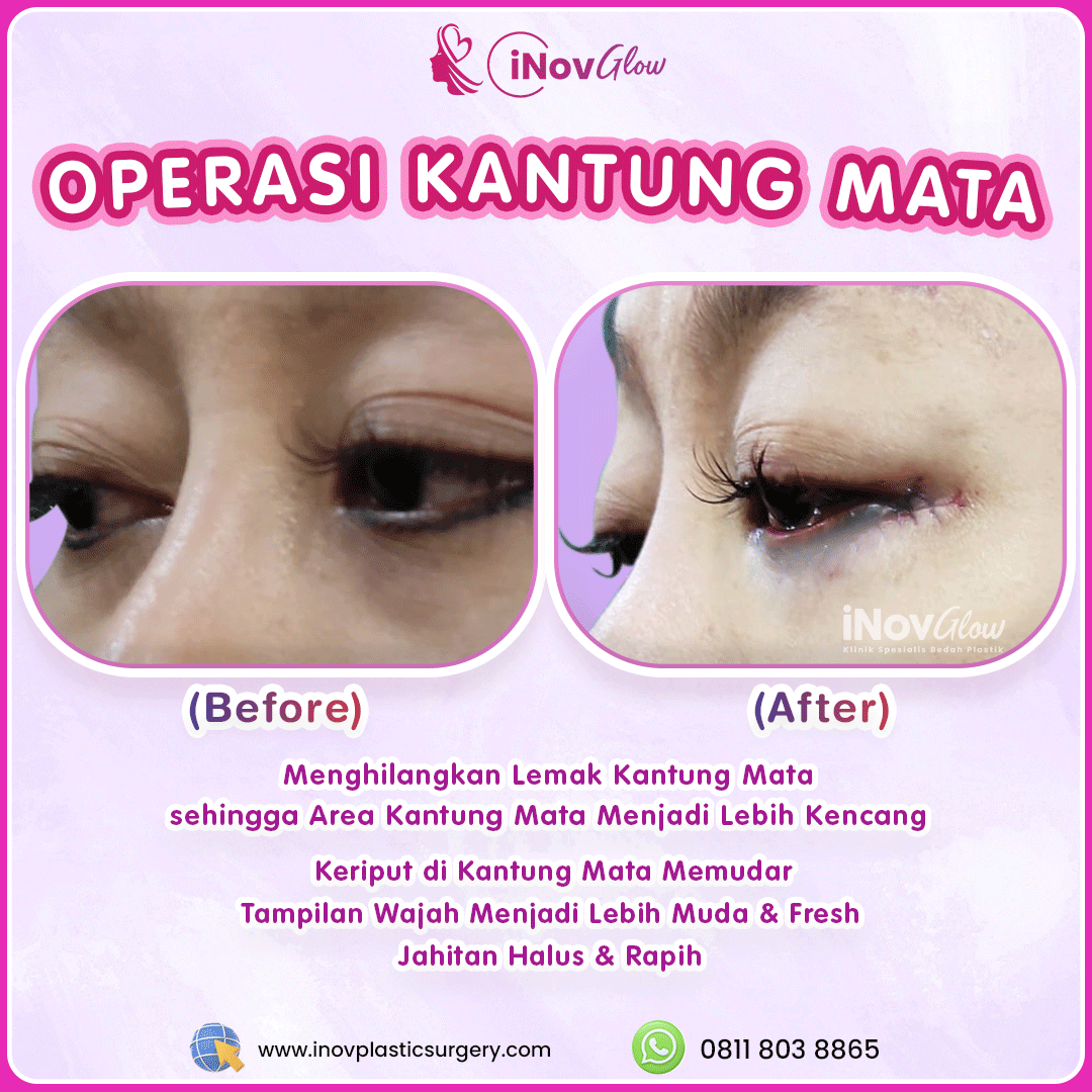 Operasi-Kantung-Mata-InovGlow-Feed-001.png