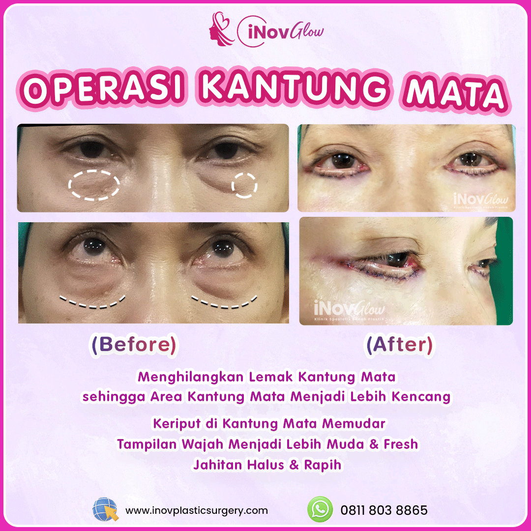 Operasi-Kantung-Mata-InovGlow-Feed-002.png