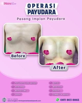 Payudara Asimetri Mengganggu Penampilan? Augmentasi Hadir Sebagai Solusi Terbaik