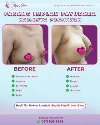 Mengapa Berhenti Merokok Penting Sebelum Operasi Payudara? Penjelasan Lengkapnya!