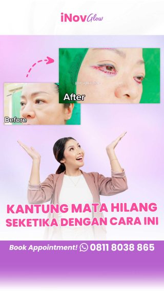 Jangan Panik! Pahami Komplikasi Umum dan Penanganan Terbaik Setelah Blepharoplasty