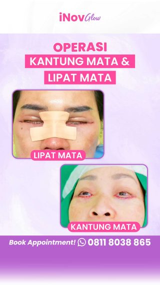 Jangan Panik! Pahami Komplikasi Umum dan Penanganan Terbaik Setelah Blepharoplasty