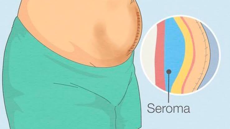 Mengenal Seroma: Munculnya Kantung Cairan Setelah Sedot Lemak dan Cara Mengatasinya
