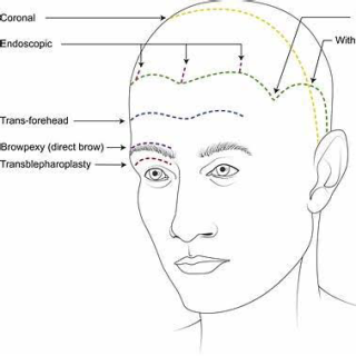 Wajib Tahu! Pertimbangan Utama Sebelum Melakukan Prosedur Forehead Lift