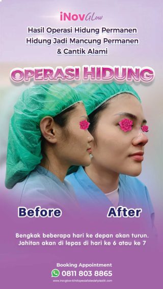 Ingin Bentuk Hidung Ideal? Ini Jenis Bentuk Hidung yang Bisa Diatasi Rhinoplasty!