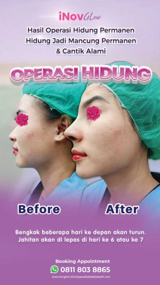 Ingin Operasi Hidung Minimal Invasif? Pahami Rhinoplasty Tertutup dan Manfaatnya di Sini!