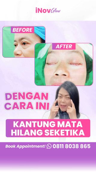 Jangan Panik! Pahami Komplikasi Umum dan Penanganan Terbaik Setelah Blepharoplasty