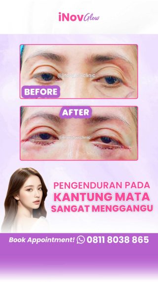 Jangan Panik! Pahami Komplikasi Umum dan Penanganan Terbaik Setelah Blepharoplasty
