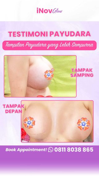 Tidur Nyenyak Setelah Pembesaran Payudara? Tips dan Trik Agar Pemulihan Lancar