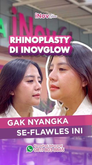Ingin Operasi Hidung Minimal Invasif? Pahami Rhinoplasty Tertutup dan Manfaatnya di Sini!
