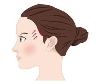 Tren Terbaru! Facelift "Kuncir Ekor Kuda": Solusi Wajah Kencang dan Mata Terbuka