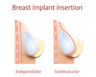 Implan Payudara di Bawah atau di Atas Otot? Kenali Pro dan Kontra Penempatan untuk Keputusan Terbaik Anda