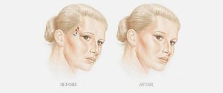 Prosedur Pengencangan Pelipis: Apa yang Perlu Anda Ketahui untuk Tampilan Wajah Lebih Segar?