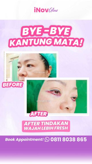 Penyebab Mata Asimetris Setelah Operasi Kelopak Mata. Baca Penjelasan Medisnya!