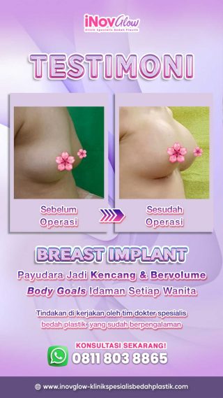 Mengenal Tipe Hipoplasia Payudara & Cara Mengatasinya