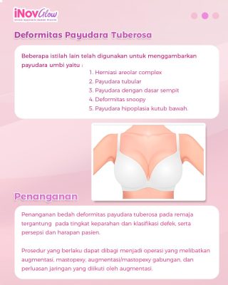 Mengenal Tipe Hipoplasia Payudara & Cara Mengatasinya