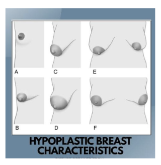 Mengenal Tipe Hipoplasia Payudara & Cara Mengatasinya