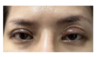 Penyebab Mata Asimetris Setelah Operasi Kelopak Mata. Baca Penjelasan Medisnya!