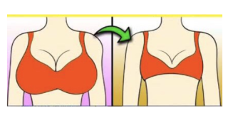 Pengaruh Fluktuasi Berat Badan Terhadap Implan Payudara
