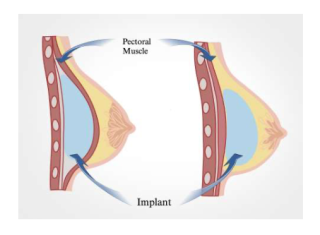 Di Atas vs Di Bawah Otot: Mana Posisi Implan Payudara Terbaik Untuk Anda? Klik Faktanya!