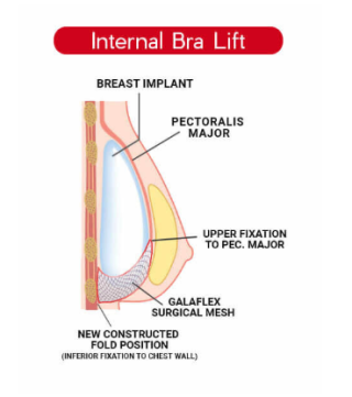 Apa Itu Bra Internal? Solusi Payudara Kencang Lebih Lama, Cek Kelebihannya!